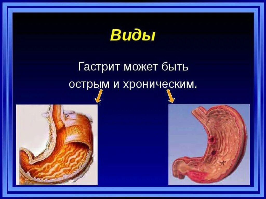 Острый и хронический гастрит. Острый гастрит презентация. Виды хронического гастрита