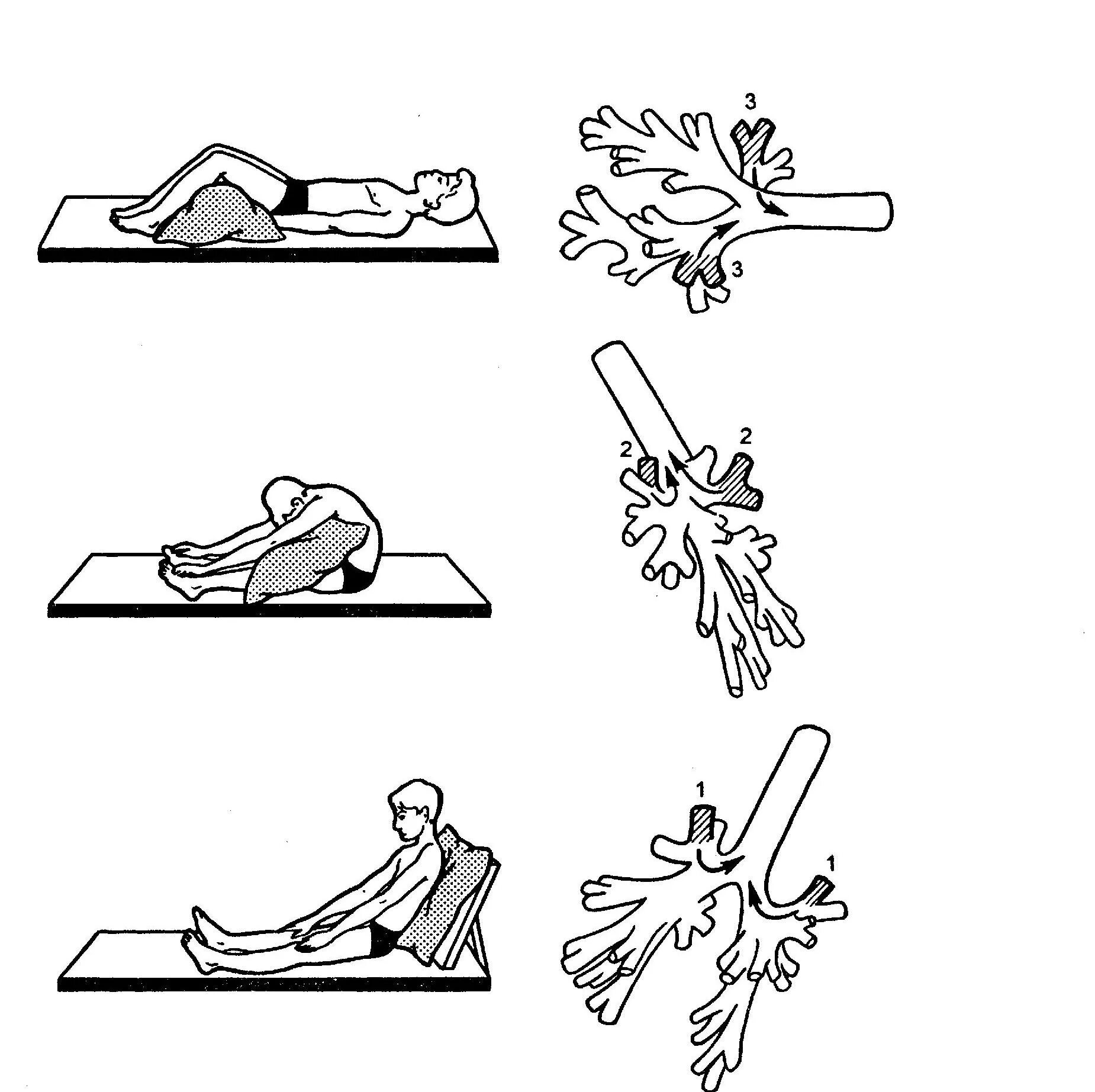 Постуральный массаж. Бронхоэктатическая болезнь Постуральный дренаж. Дренажные положения для отхождения мокроты. Постуральный дренаж бронхов. Постуральный дренаж и дренажную гимнастику.