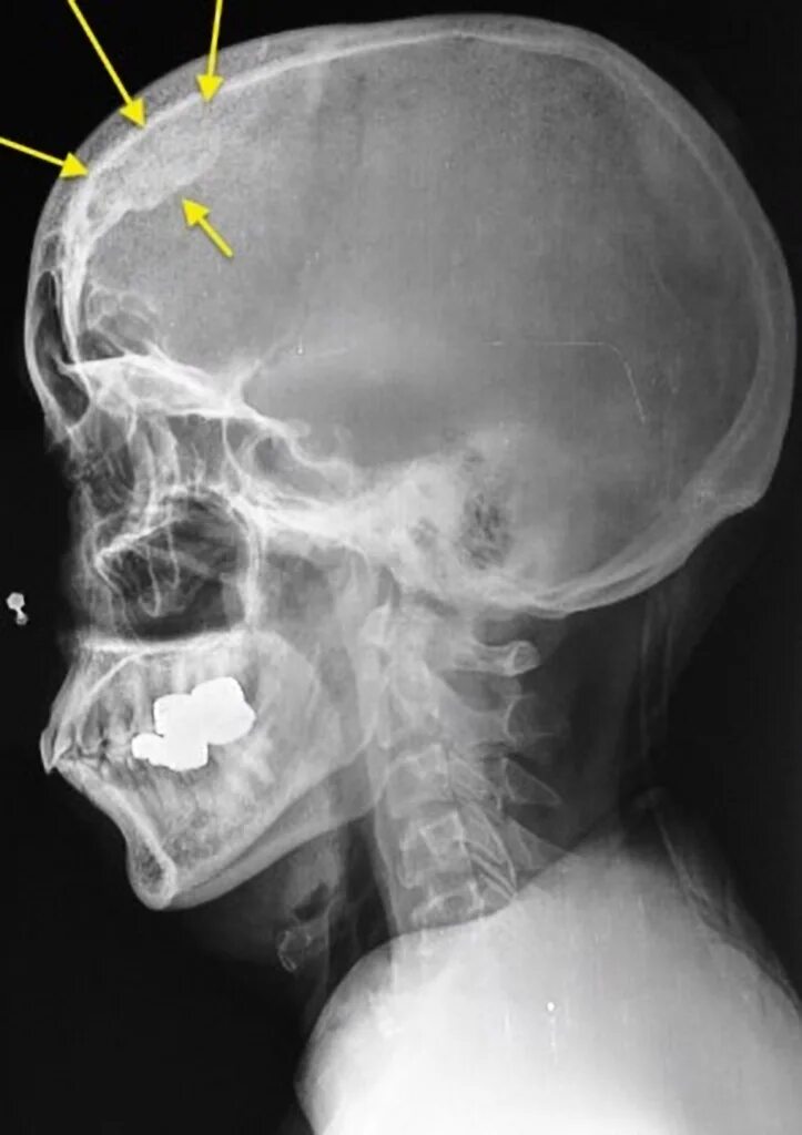 Гиперостоз черепа рентген. Костный экзостоз костей черепа. Гиперостоз лобной кости рентген. Гиперостоз костей черепа рентген.