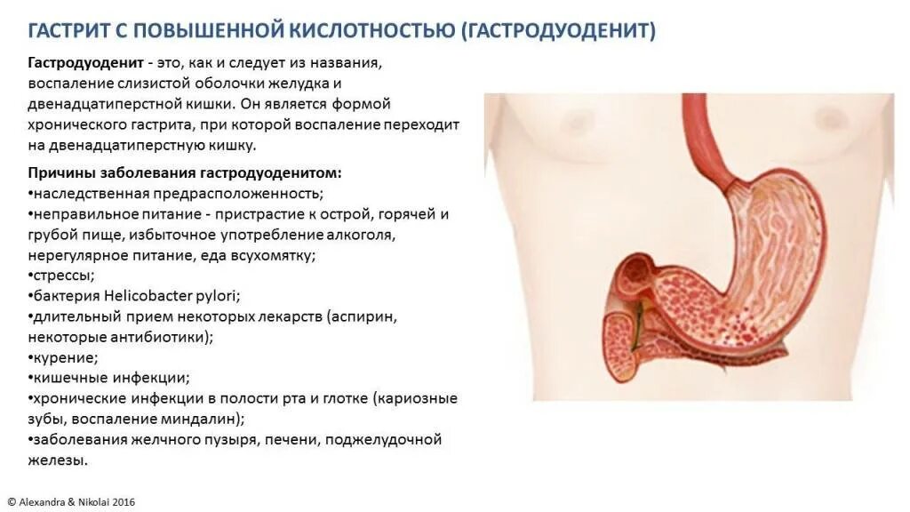 Сколько лечат гастрит. Гастродуоденит пониженной секрецией это. Хронический гастродуоденит с повышенной кислотностью. Хронический гастродуоденит синдромы. Гастрит повышенная кислотность.