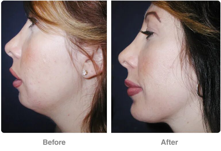 Ментопластика челюсти. Скошенный подбородок. Крупные надбровные дуги. Ринопластика подбородка. Нижняя челюсть немного искривлена череп.