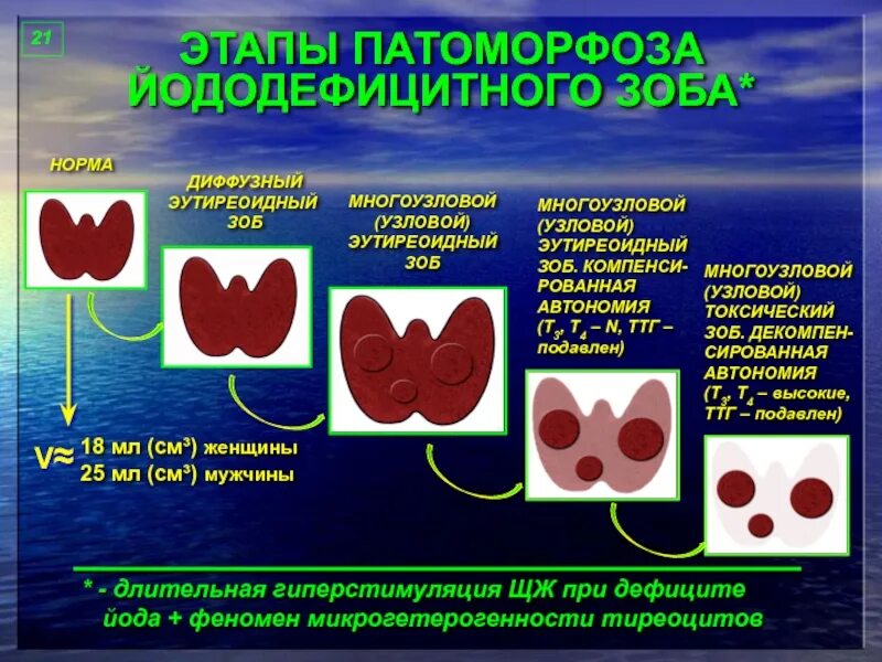 Многоузловой зоб 1 степени щитовидной железы. Узловой эутиреоидный зоб. Узловой эутиреоидный зоб степени.
