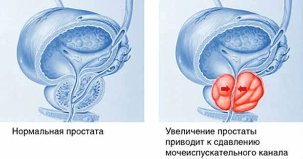 Простата нормальная и воспаленная. Увеличенная предстательная железа.