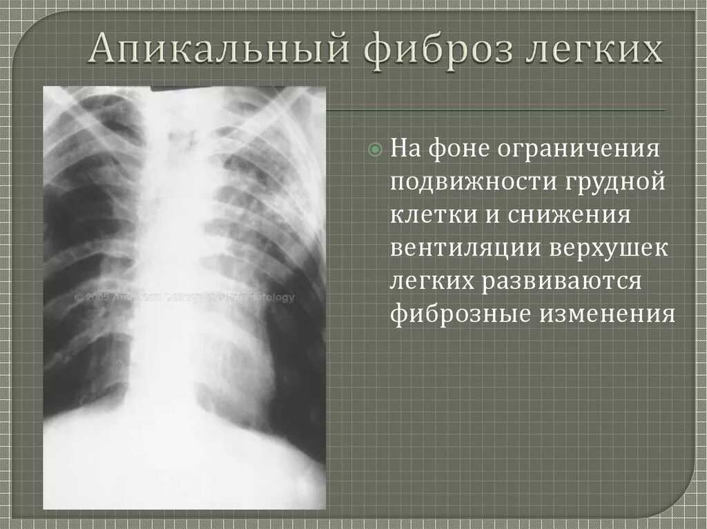 Фиброз обеих легких. Плевральные наслоения. Апикальные отделы легких.