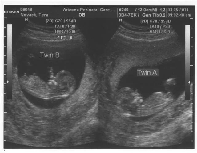 УЗИ 12 недель беременности двойня. УЗИ двойняшек на 10 неделе беременности. УЗИ 10 недель многоплодной беременности. Фото УЗИ двойни на 10 неделе беременности.