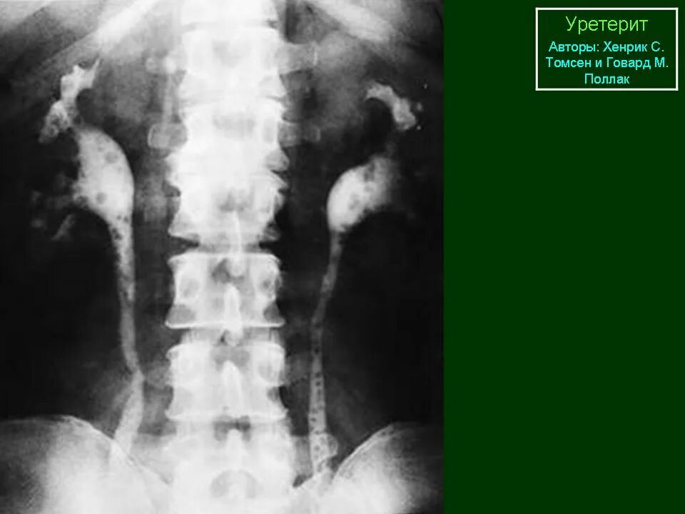 Рентген мочеточника. Удвоение мочеточника рентген. Расширение мочеточника рентген. Аномалии мочеточников рентген. Опухоль мочеточника рентген.