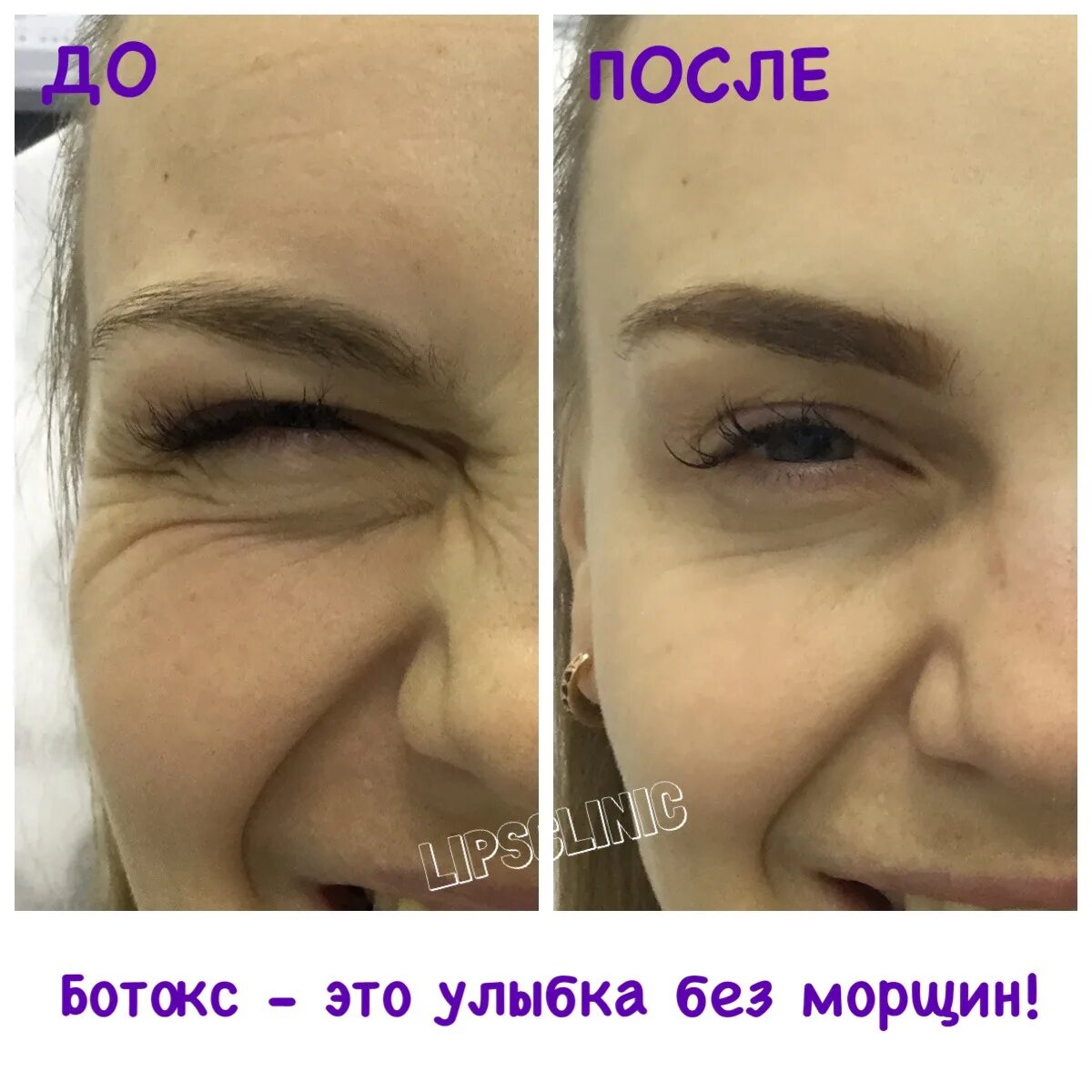 Ботокс по дням фото Ботокс начал действовать: найдено 90 изображений