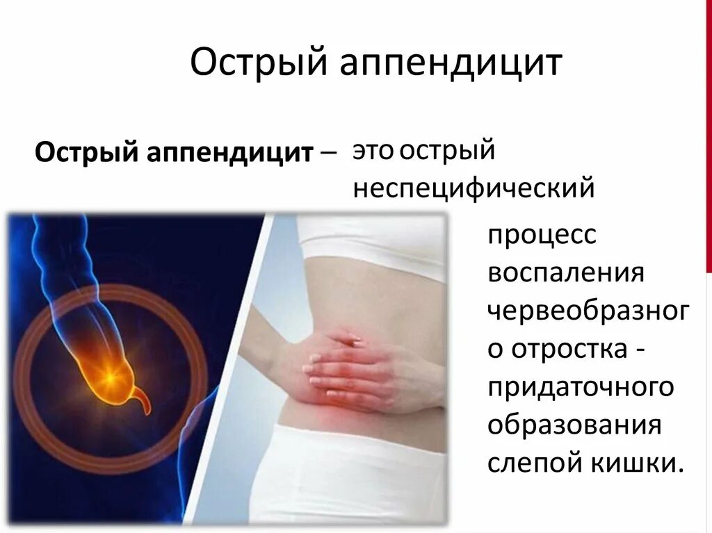 Можно ли пить при аппендиците. Памятка острый аппендицит. Симптомы аппендицита кратко. Аппендицит причины и профилактика.