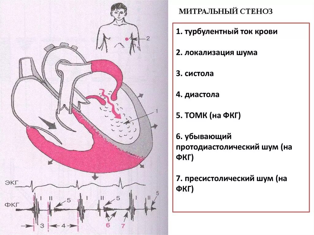 Митральный аортальный стеноз. Пороки сердца митральный стеноз. Пороки митрального клапана стеноз. Сердце при митральном стенозе схема. Митральный стеноз изменения гемодинамики.