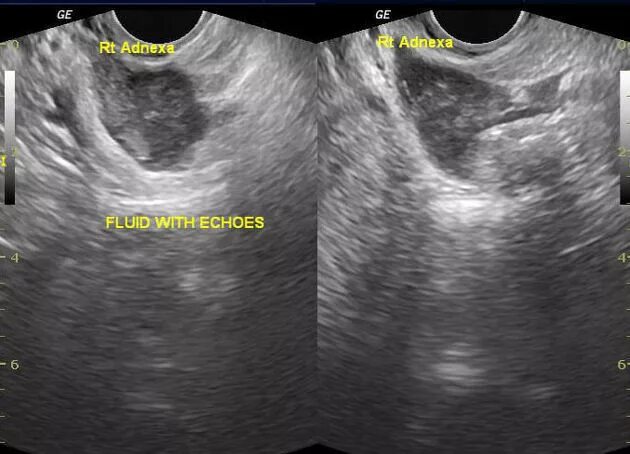 Можно перепутать беременность с кистой. Внематочная Трубная беременность УЗИ. Внематочная беременность в трубе УЗИ. Шеечная внематочная беременность УЗИ. Внематочная беременность 2-3 недели на УЗИ.
