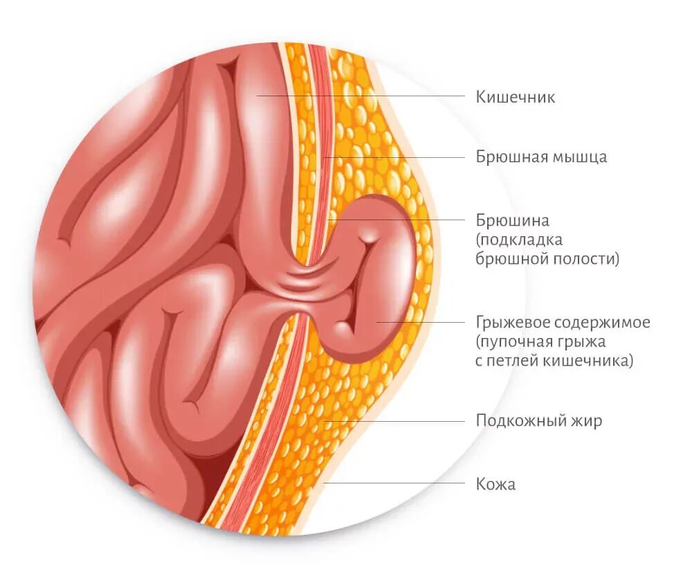 Как понять что грыжа