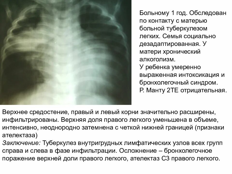 Признаки ателектаза легкого. Ателектаз рентген заключение. Ателектаз верхней доли правого легкого на рентгене. Компрессионный ателектаз легкого. Субтотальный ателектаз легкого рентген.