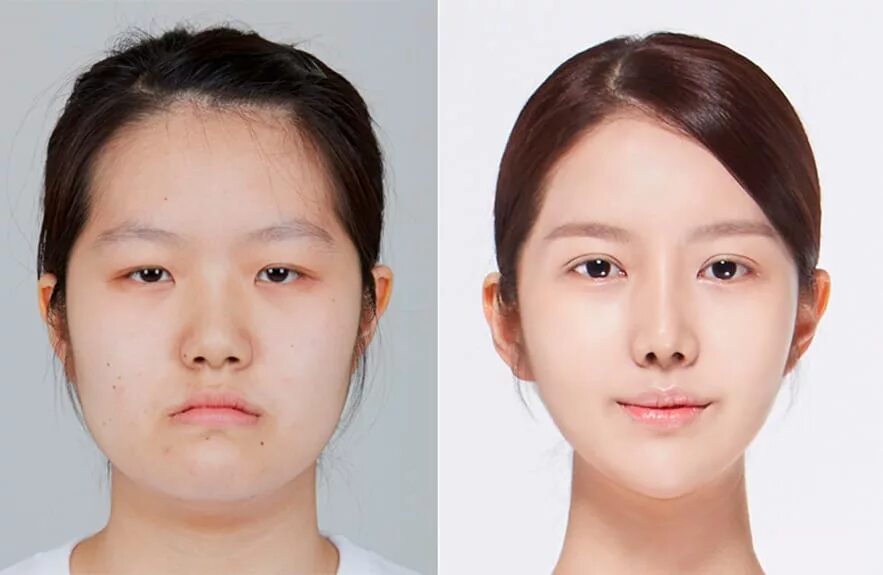 Изменение формы клетки. Пластика скуловых костей азиаты. Кореянки пластика. Клетки способные изменять форму. Уменьшение нижней челюсти.