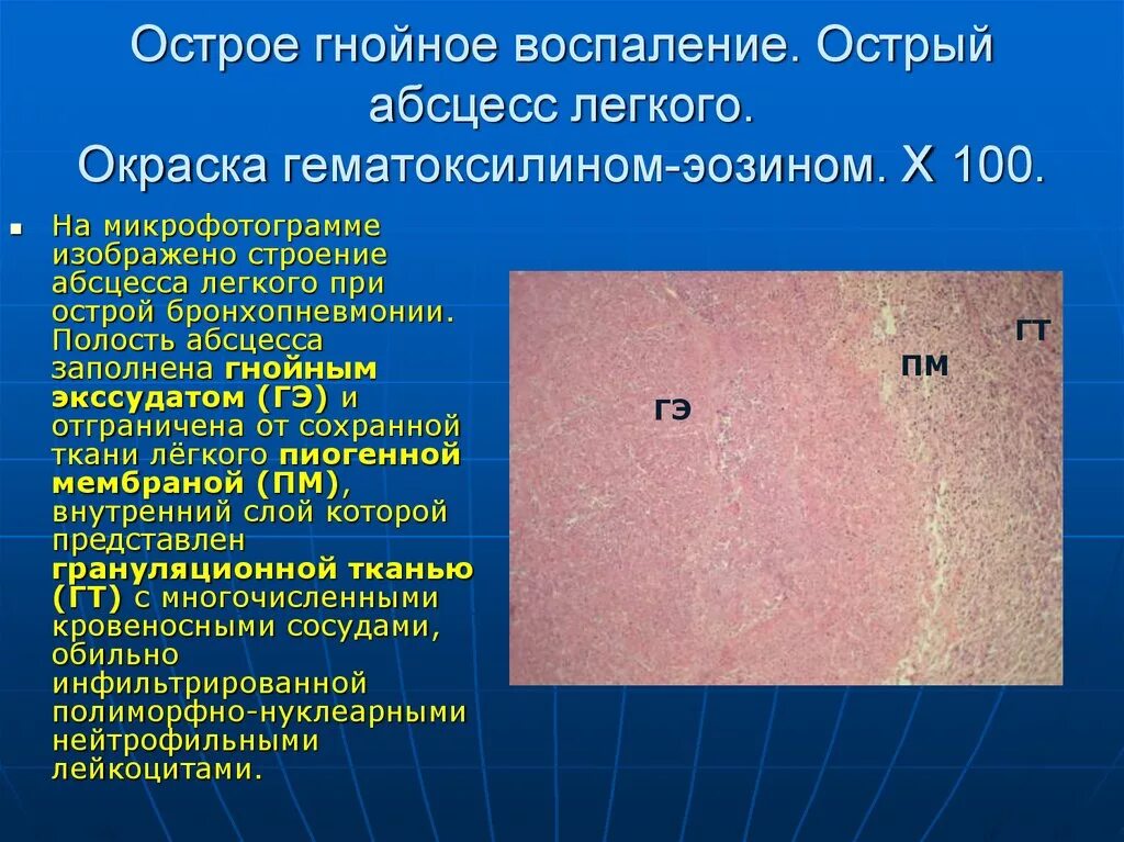 Гнойное воспаление мягких. Абсцесс легкого микропрепара. Хронический абсцесс легкого микропрепарат. Острый абсцесс легкого патанатомия. Абсцесс лёгкого патанатомия.