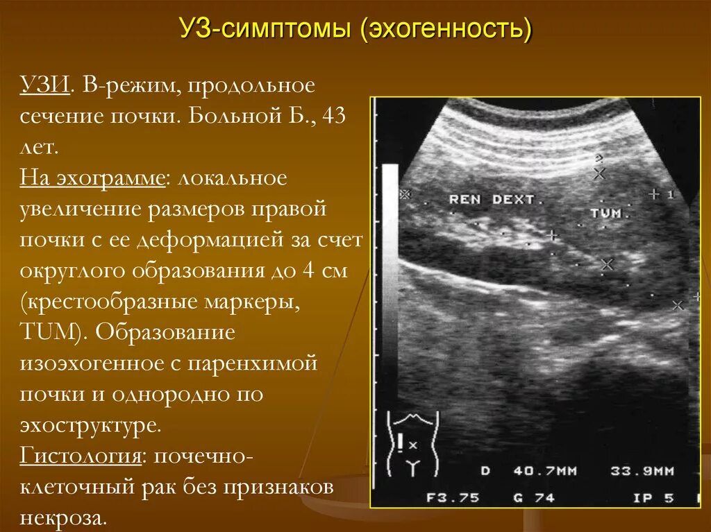 Ультразвуковое исследование почек (УЗИ). Эхогенность на УЗИ. Эхогенность при ультразвуковом исследовании. Почка при УЗИ. Печень эхогенность неоднородная