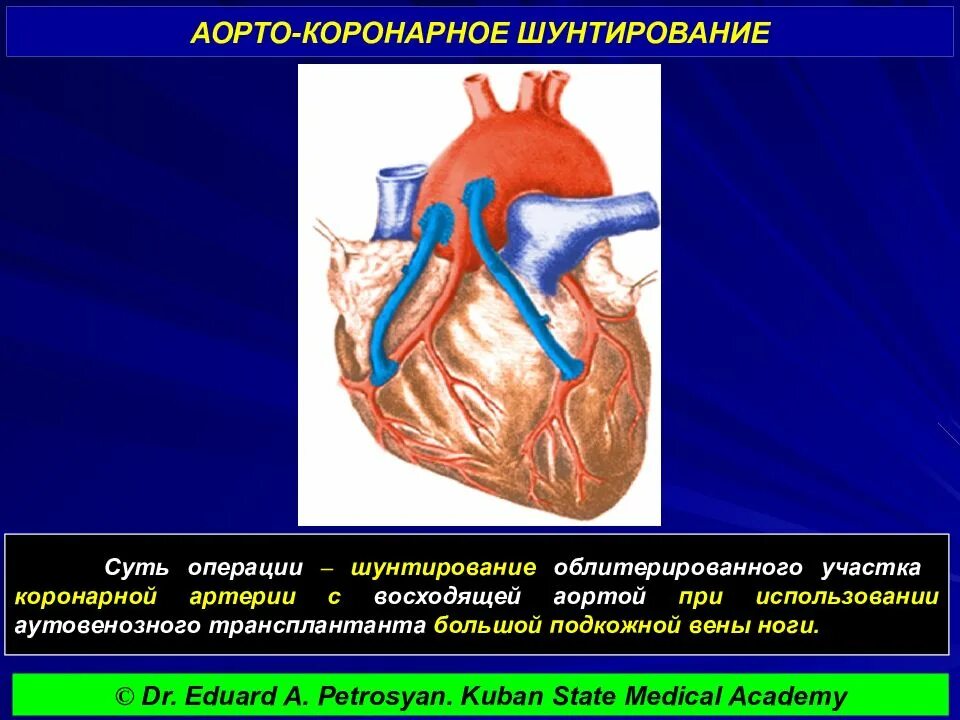 Маммарокоронарное шунтирование сердца. Коронарное шунтирование сосудов сердца. Схема операции аортокоронарного шунтирования. Артерио коронарное шунтирование.