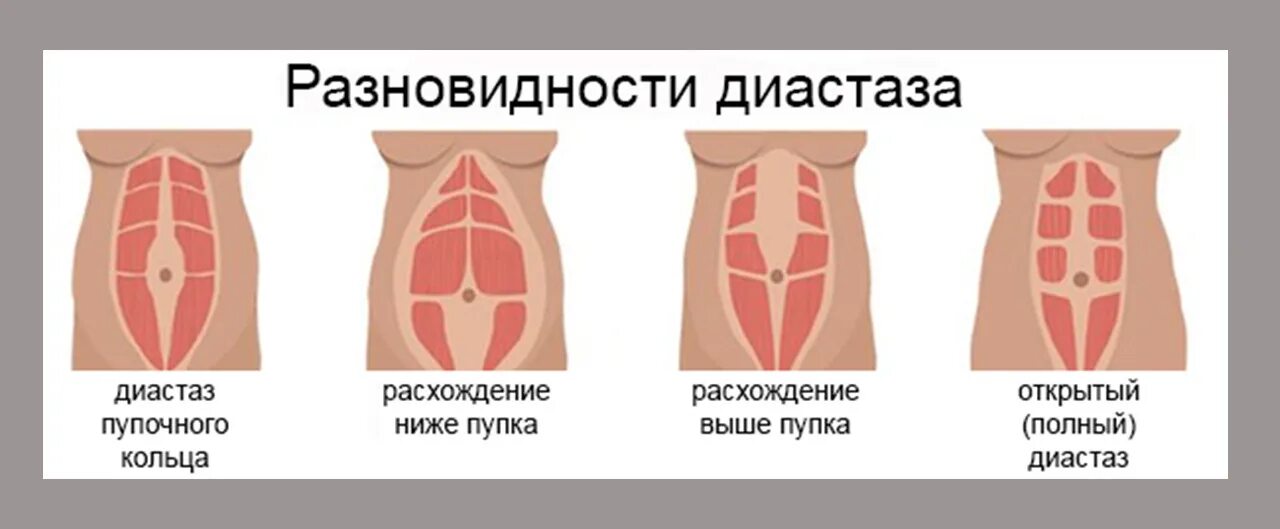 Операция при диастазе мышц живота. Диастаз прямых мышц после родов.