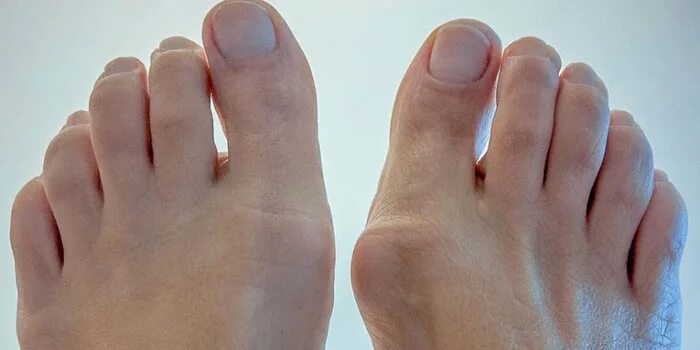 Подагра-надводная часть айсберга. Подагра суставов пальцев ног. Воспаление суставов пальцев подагра. Подагра плюснефалангового сустава. Подагра отложение кристаллов.