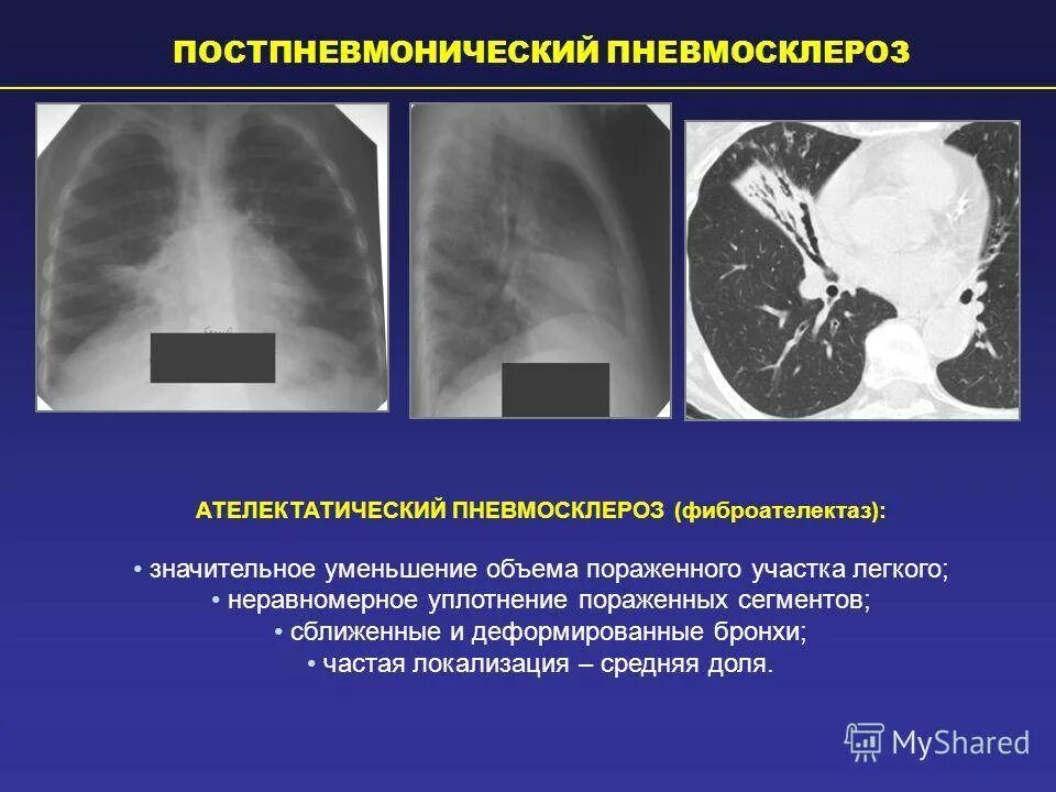 Что означает фиброзное изменение. Пневмосклероз кт признаки. Пневмосклероз легких кт. Постпневмонический пневмофиброз. Локальные участки пневмофиброза легких кт.