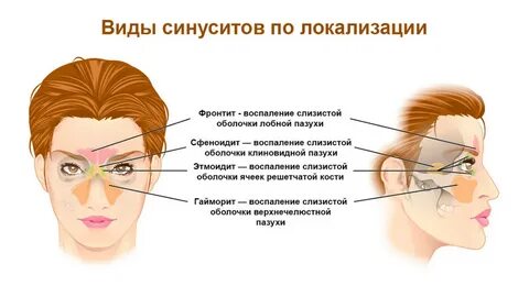 Как определить гайморит у взрослого
