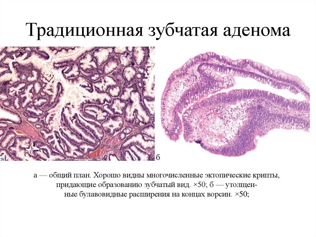 Тубулярная аденома толстой