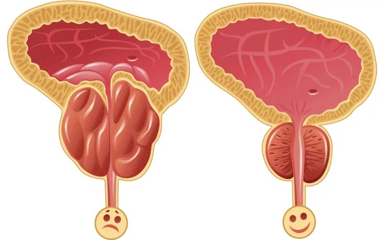 Профилактика предстательной железы. Воспаленная аденома простаты. Острый и хронический простатит. Простата рисунок.
