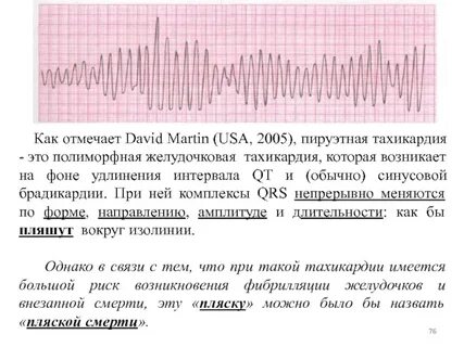 Пируэтная тахикардия