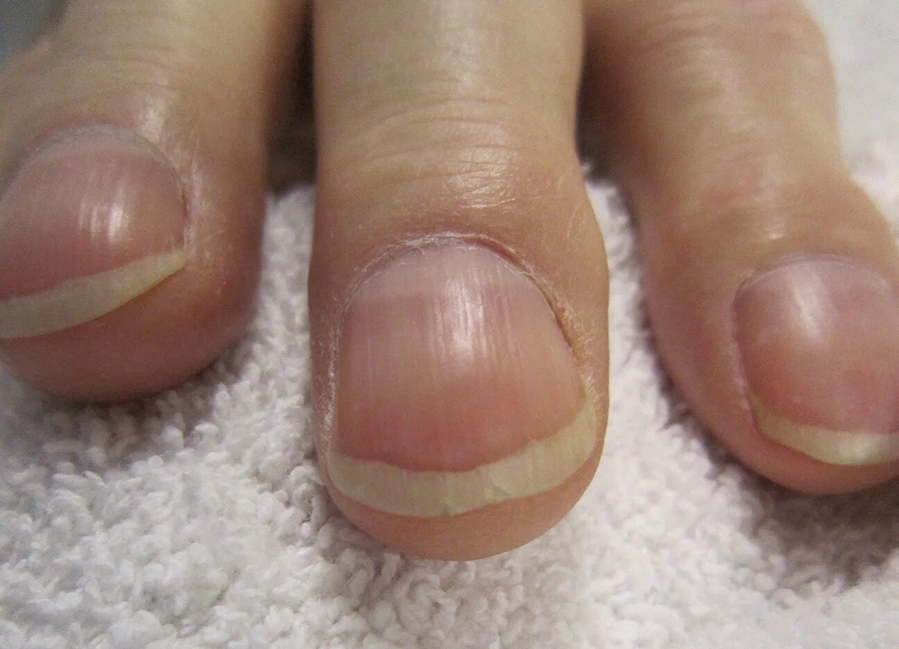 Ногти на больших пальцев мужчин. Онихолитический онихомикоз. Ониходистрофия - онихолизис.. Нормотрофический онихомикоз. Грибок ногтей онихогрифоз.
