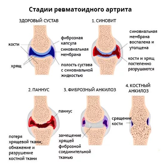 Терапия ревматоидного артрита. Ревматоидный артрит данные осмотра. Серонегативный ревматоидный артрит. Функциональный класс ревматоидного артрита. Ревматоидный артрит преодоление.