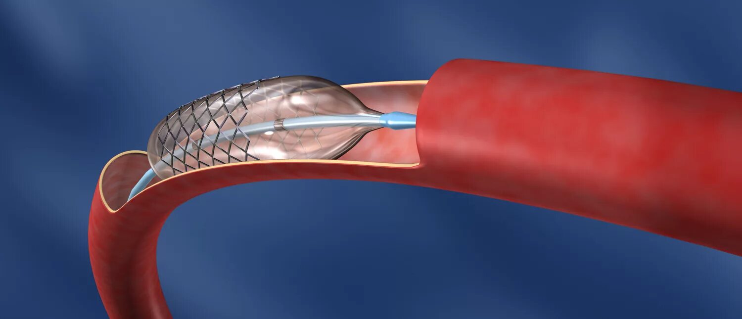 Стенты для сосудов. Баллонная ангиопластика артерий. Эндоваскулярная баллонная ангиопластика. Стентирование сосудов сердца. Эндоваскулярная стентирование сосудов.