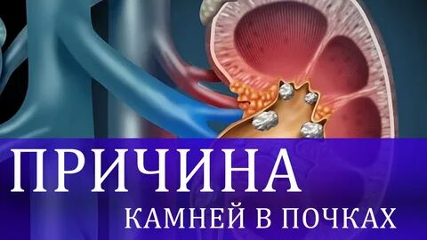 Почки. Решение проблем. - смотреть онлайн все 11 видео от Почки. Решение проблем