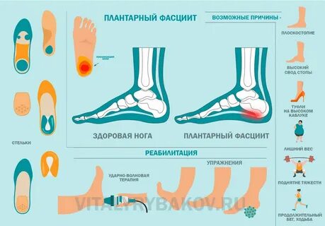 Плантарный фасциит стопы как лечить