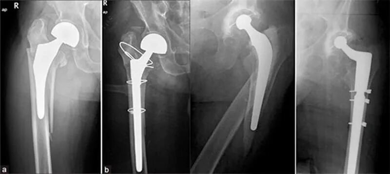 Перелом эндопротеза тазобедренного сустава. Ревизионное тотальное эндопротезирование тазобедренного сустава:. Перипротезный перелом тазобедренного сустава. Перелом шейки бедра рентген протез. Перелом шейки бедра лечение операции