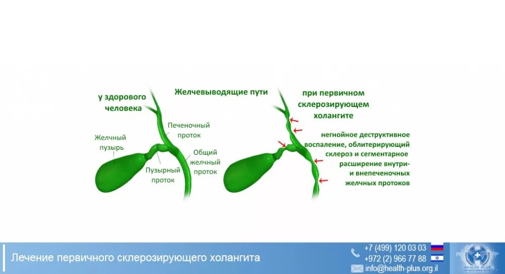 Болезнь желчных протоков. Заболевания желчевыводящих путей. Заболевания желчных путей. Холангит желчных протоков. Воспаление желчных протоков.