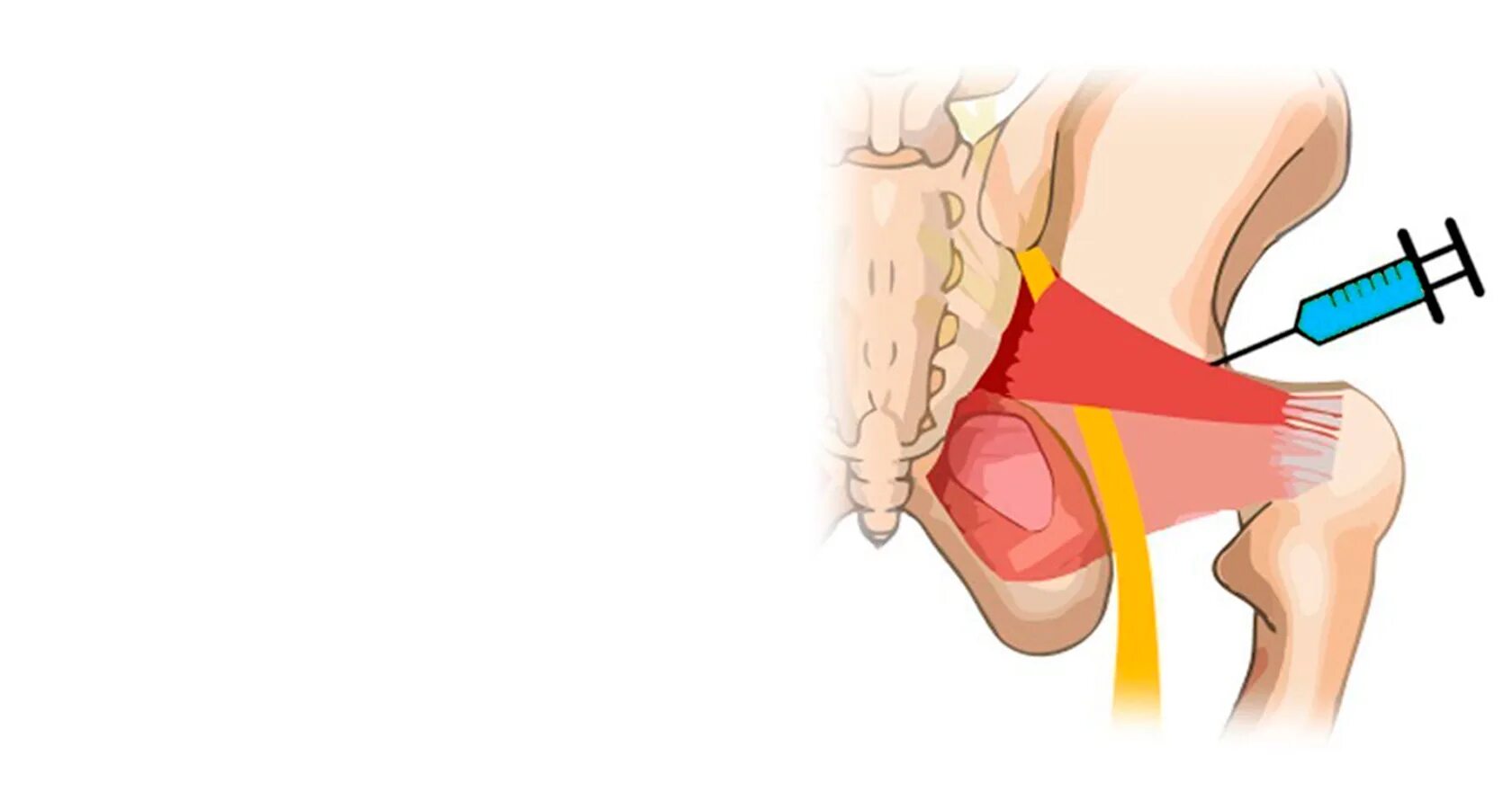 Блокада при защемлении седалищного. Синдром грушевидной мышцы блокада. Техника блокады при синдроме грушевидной мышцы. Блокада грушевидной мышцы. Блокада грушевидной мышцы техника.