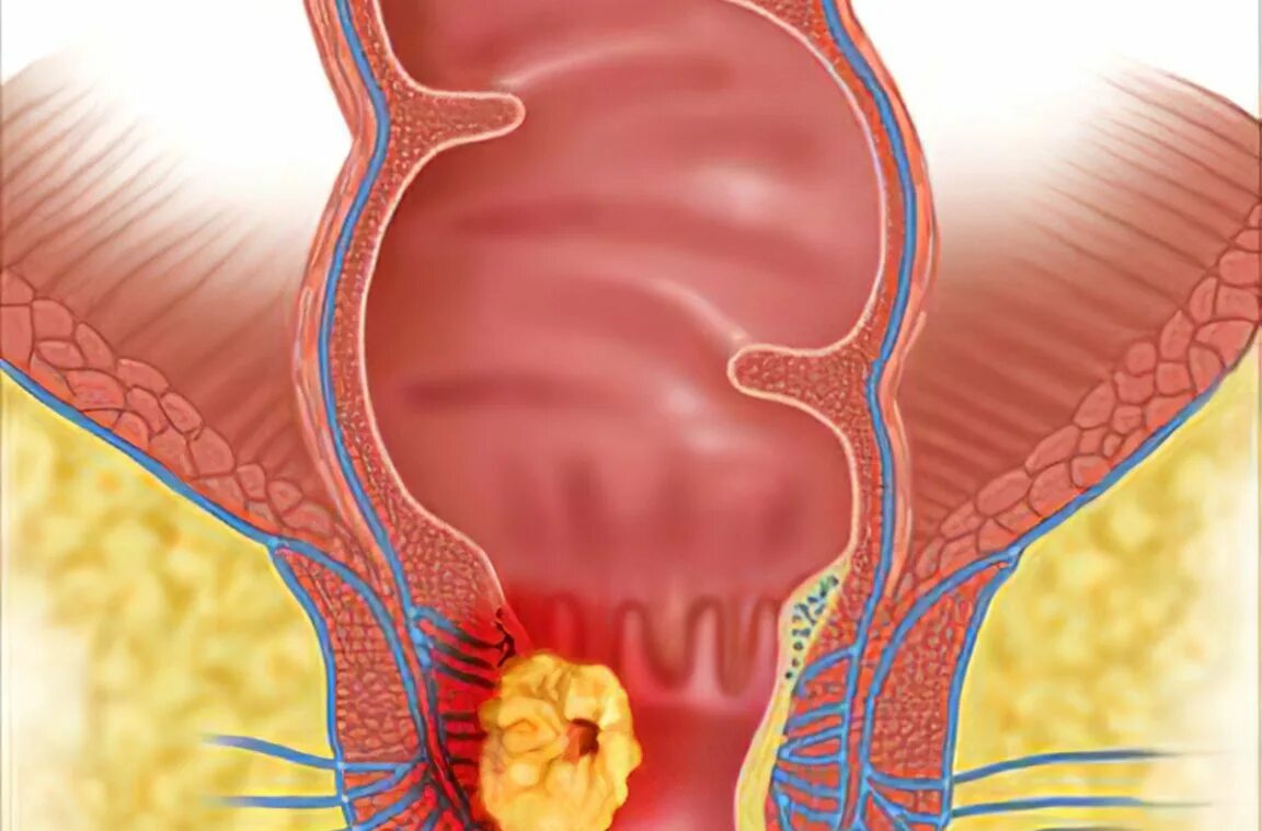 перианальная бахромка. сфинктерит прямой кишки симптомы лечение. синдром одди. сфинктерит прямой кишки симптомы лечение. спазм анального сфинктера.
