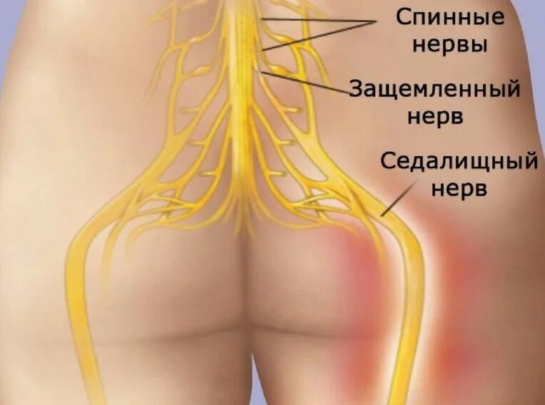 Боль в спине защемление нерва. Нерв в ягодице. Неврит седалищного нерва. Защемление седалищного.