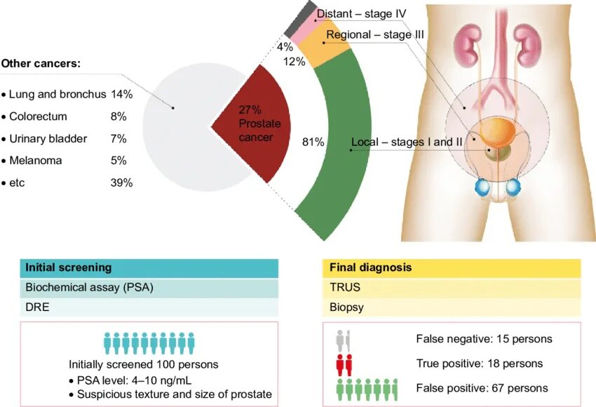 Prostate Cancer- diagnosis and Staging. Prostate Cancer перевод. Prostate перевод. Stages of cancer