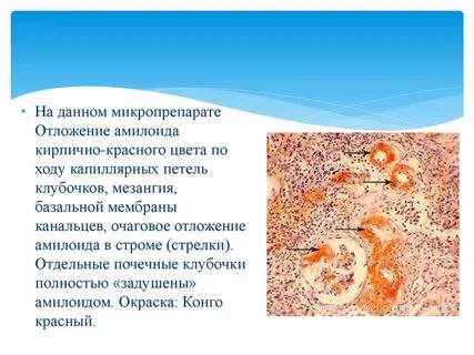 Почечный амилоидоз