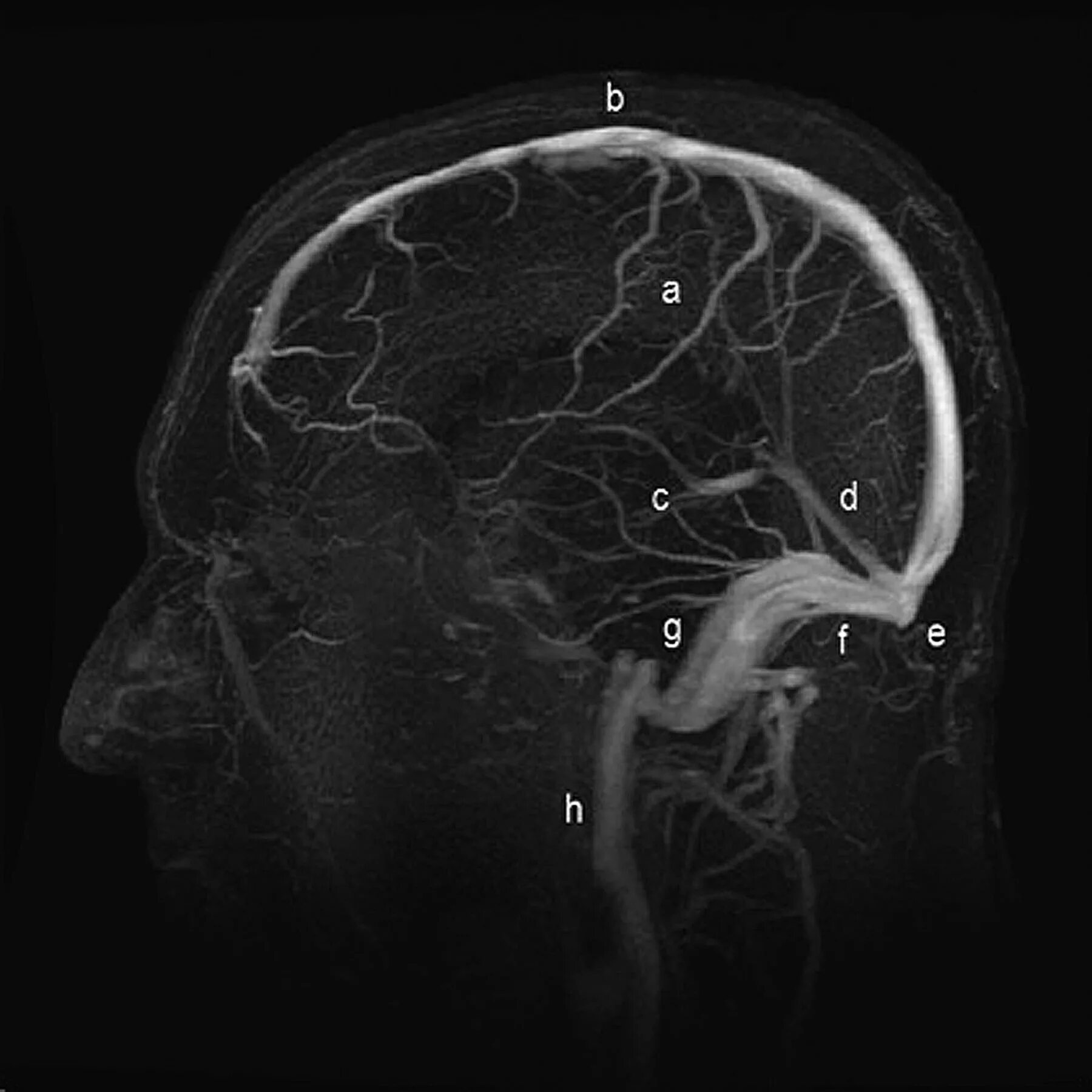Венография головного мозга. Кт-венография тромбоз сосудов головы. Магнитно резонансная венография, венозные синусы головы. Сосуды головного мозга кавернозный синус.
