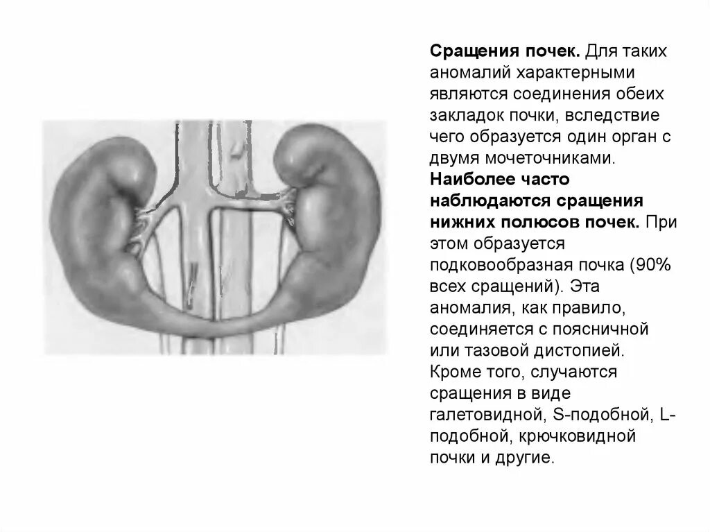 Подковообразная и галетообразная почка. Аномалии развития почек сращение. Аномалия развития почек подковообразная. Сращение почек нижними полюсами.