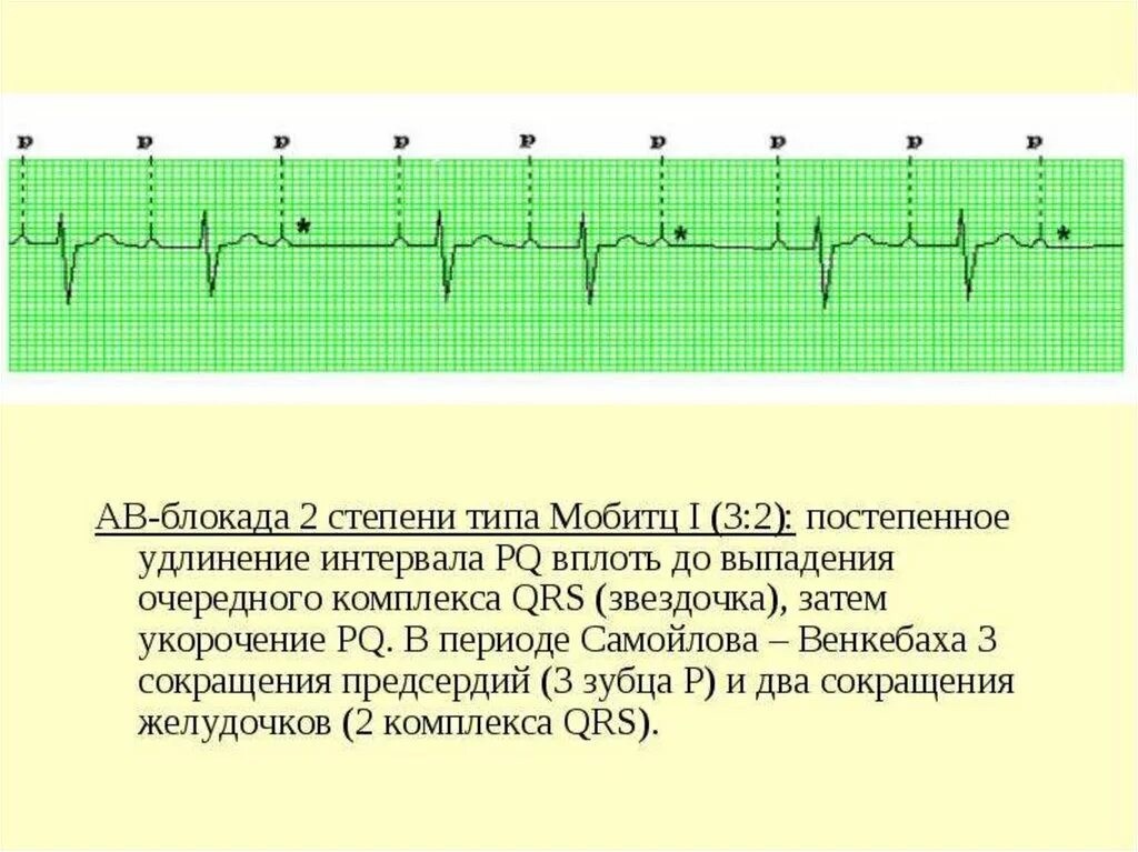 Атриовентрикулярная блокада 2. Ab блокада 2 степени Мобитц 1. Av блокада 2 степени Тип 2 Мобитц 2. АВ блокада 2 степени, 1 Тип (Мобиц 1). АВ блокада 2 степени Мобитц 2 2 к 1.