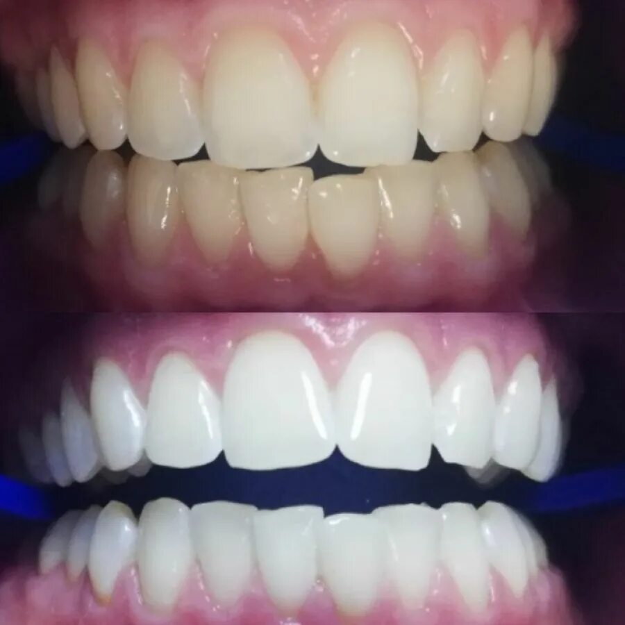 Лазерное отбеливание отзывы. Зубы до и после отбеливания. Отбеление зубов до после.