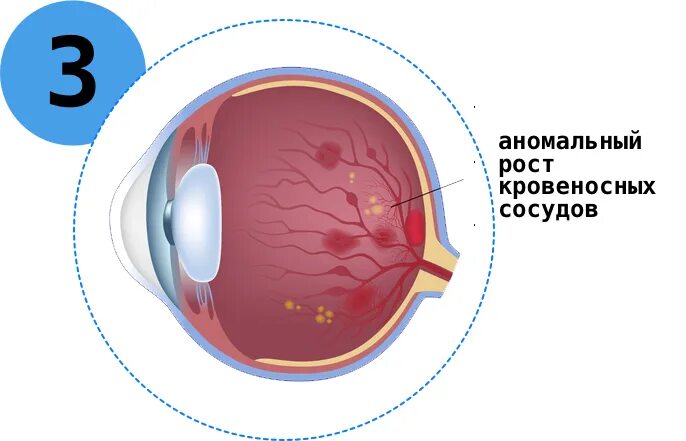 Гемофтальм мкб 10. Ангиопатия сетчатки обоих глаз.