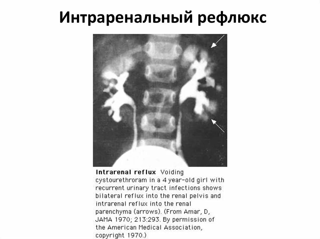 Рефлюкс у ребенка форум. Пиелоренальный рефлюкс рентген. пиеловенозный рефлюкс. пиелоуретральный рефлюкс. форникальный рефлюкс почек.