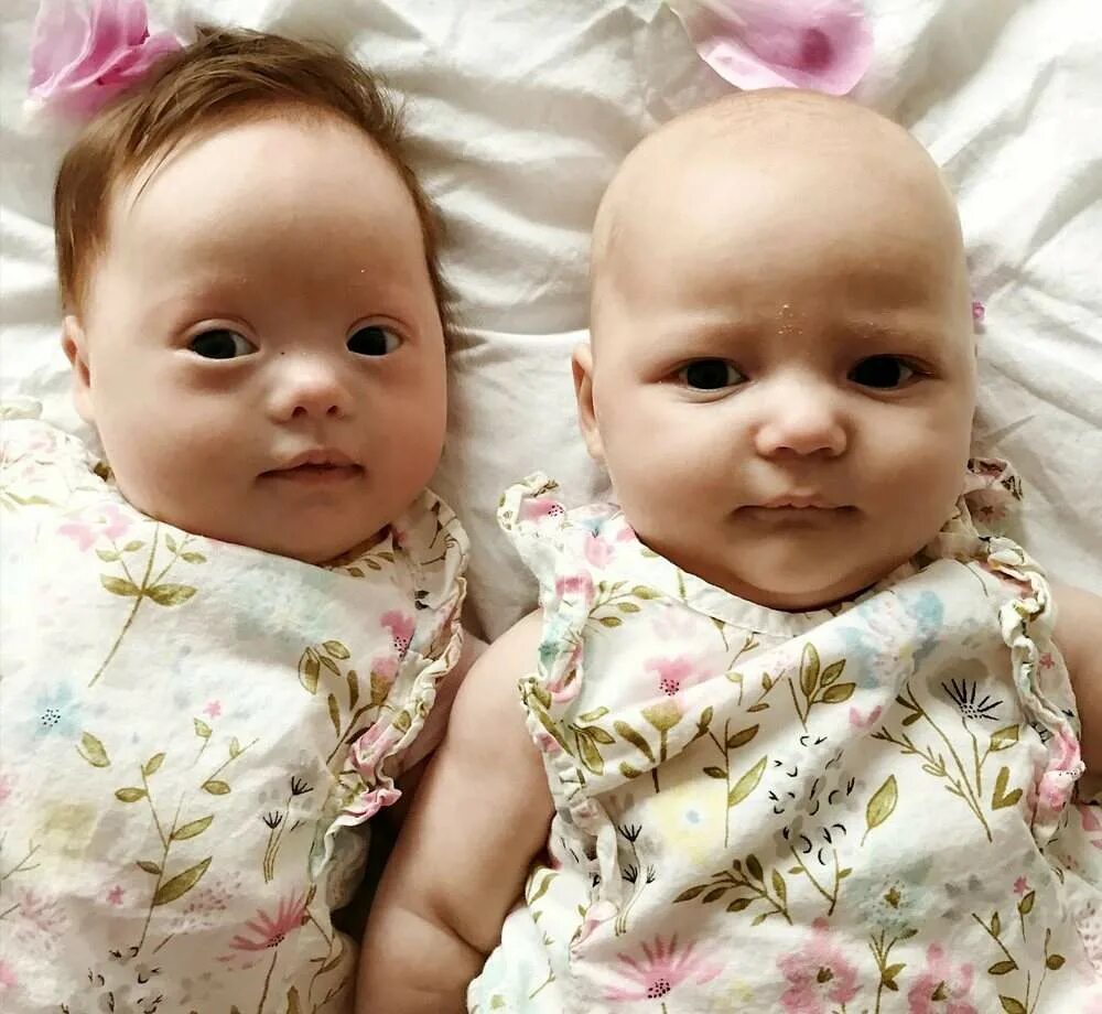 Родились двойняшки. Новорождённые дети дауны. Разнояйцевые двойняшки. Тройняшки малыши. Самые красивые тройняшки.