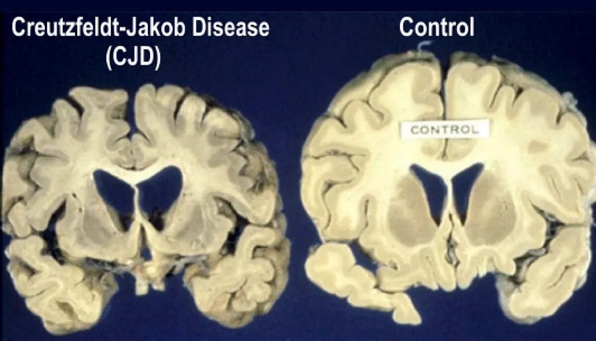 Прионы губчатая энцефалопатия. Болезнь Крейтцфельдта-Якоба. Прионы спонгиозная энцефалопатия. Хтэ болезнь