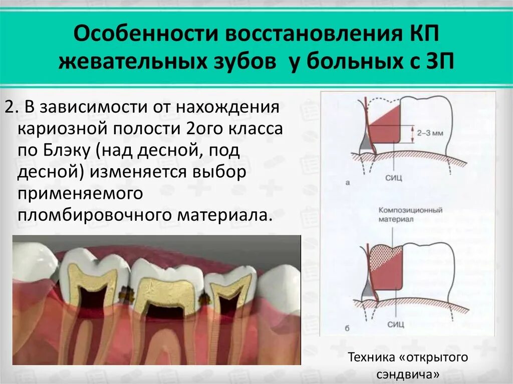 Пломбирование кариозной полости 1 класса