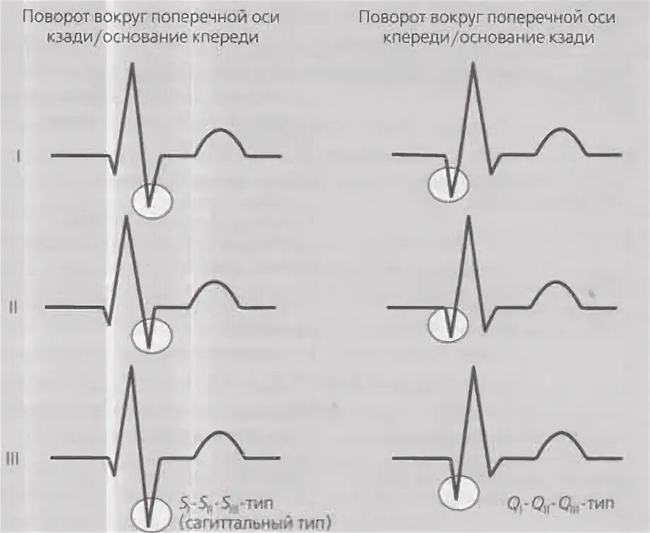 Сердце против часовой стрелки. Поворот левым желудочком кпереди на ЭКГ. Поворот сердца верхушкой вперед на ЭКГ. ЭКГ при повороте сердца верхушкой назад. Повороты сердца вокруг оси на ЭКГ.