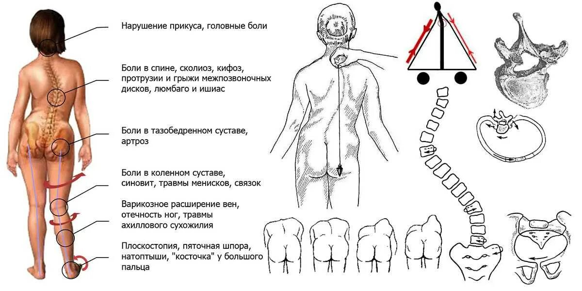 Во время движения боли. С образный и s образный сколиоз. Сколиоз схема. Правосторонний с образный сколиоз. Искривление таза и позвоночника.